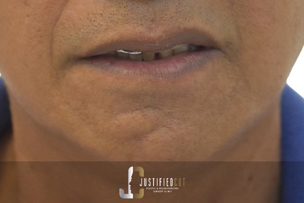 Justified Cut After Basal Cell Carcinoma Surgery