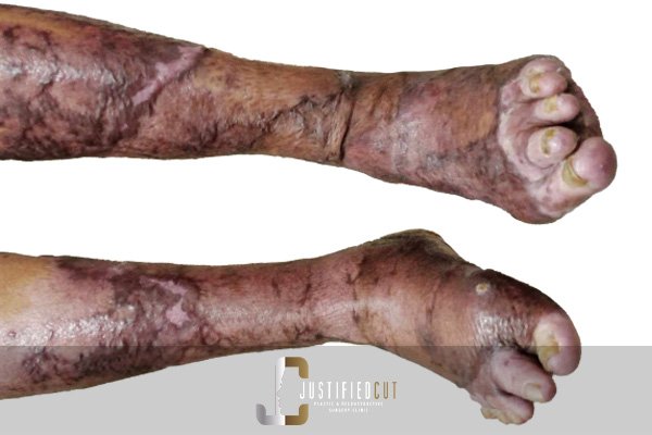 Justified Cut After Burn Complication Surgery