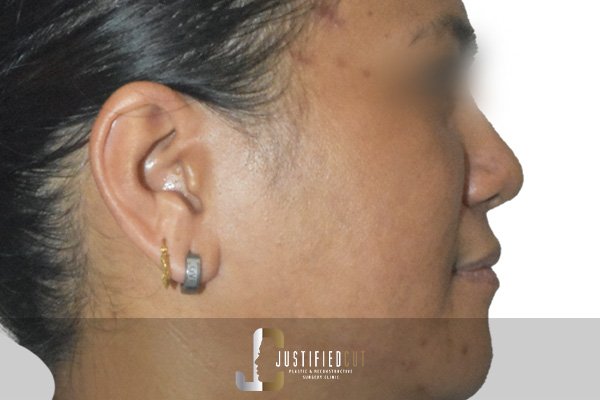 Justified Cut After Burn Procedure