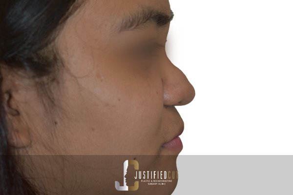 Justified Cut After Dermoid Cyst Surgery