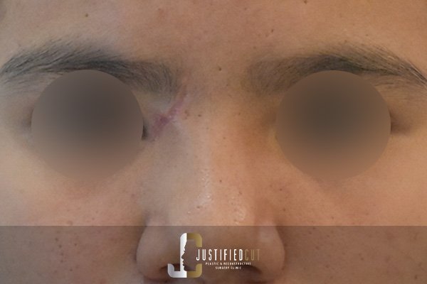 Justified Cut After ECI