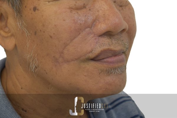 Justified Cut After Facial Flap Procedure