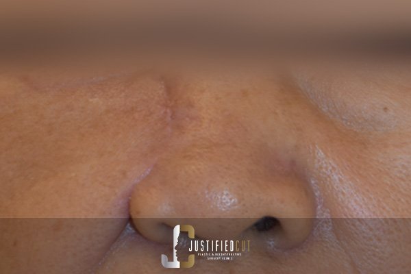 Justified Cut After Facial Flap Surgery 1