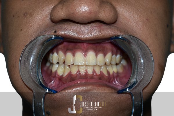 Justified Cut After Facial Fracture Surgery