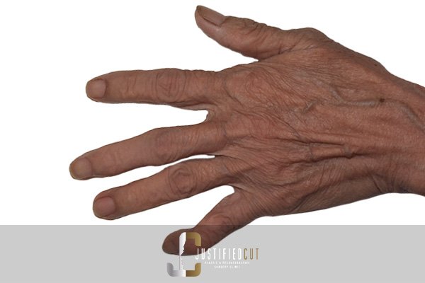 Justified Cut After Hand Injury Surgery