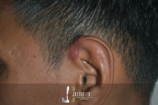 Justified Cut After Keloid Surgery 1