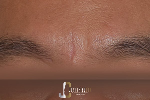 Justified Cut After Keloid Surgery