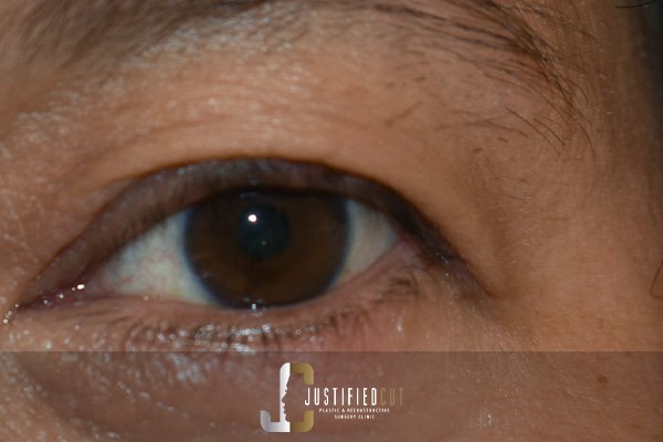 Justified Cut After Mole Surgery 2