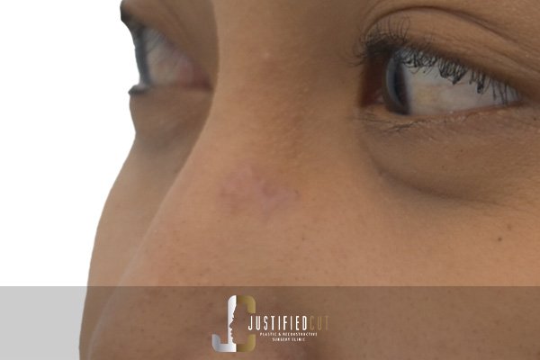 Justified Cut After Mole Surgery 4