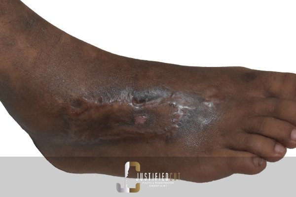 Justified Cut After Skin Graft Surgery