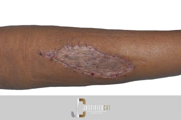 Justified Cut After Skin Grafting Arm Fracture Surgery