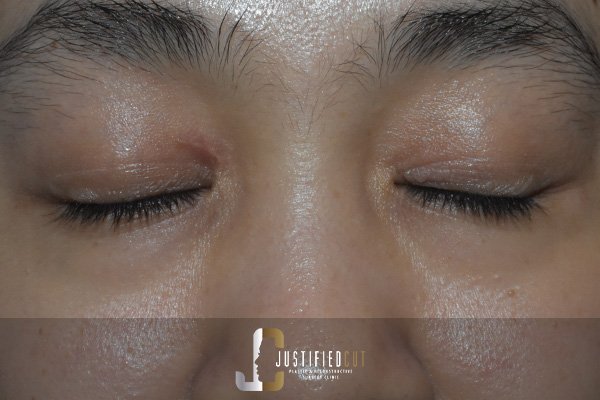 Justified Cut After Xanthelasma Surgery