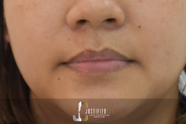 Justified Cut Avulsion After