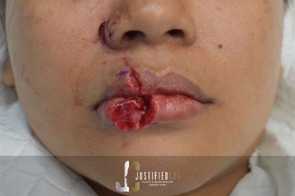 Justified Cut Avulsion Before