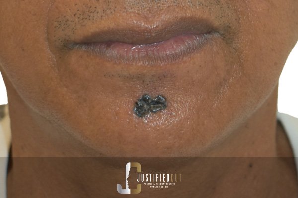 Justified Cut Before Basal Cell Carcinoma Surgery