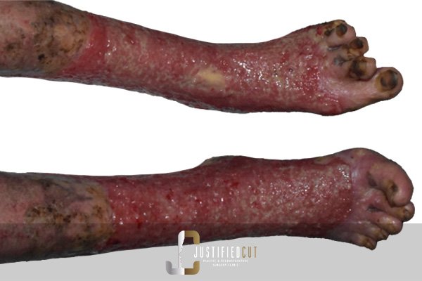 Justified Cut Before Burn Complication Surgery