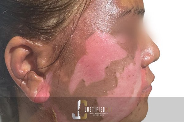 Justified Cut Before Burn Procedure