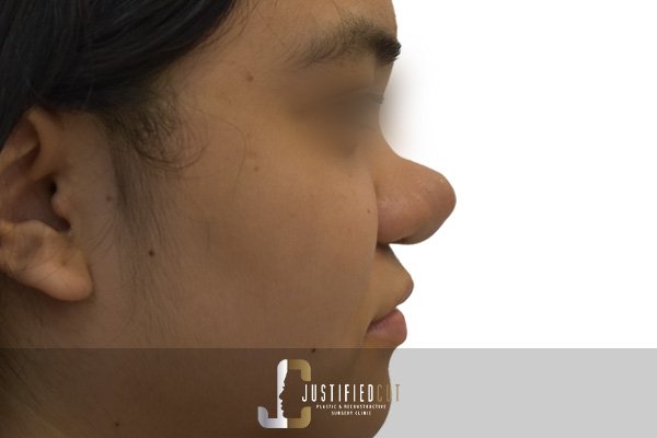 Justified Cut Before Dermoid Cyst Surgery