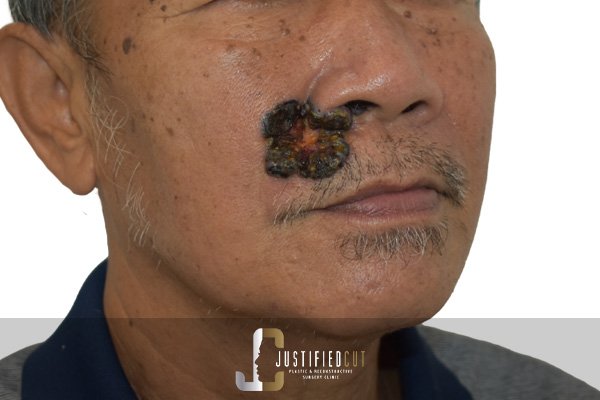 Justified Cut Before Facial Flap Procedure