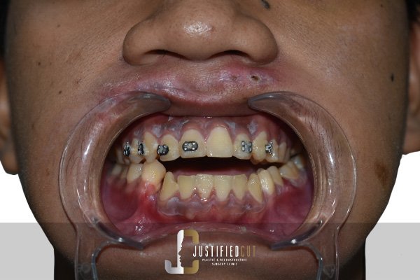 Justified Cut Before Facial Fracture Surgery