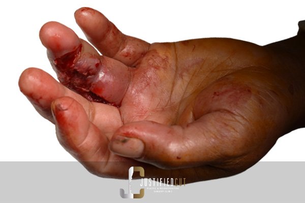 Justified Cut Before Hand Injury Surgery 1