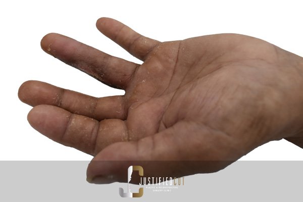 Justified Cut Before Hand Injury Surgery 2