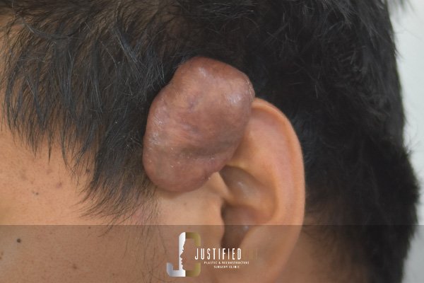 Justified Cut Before Keloid Surgery 1