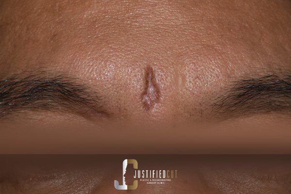 Justified Cut Before Keloid Surgery