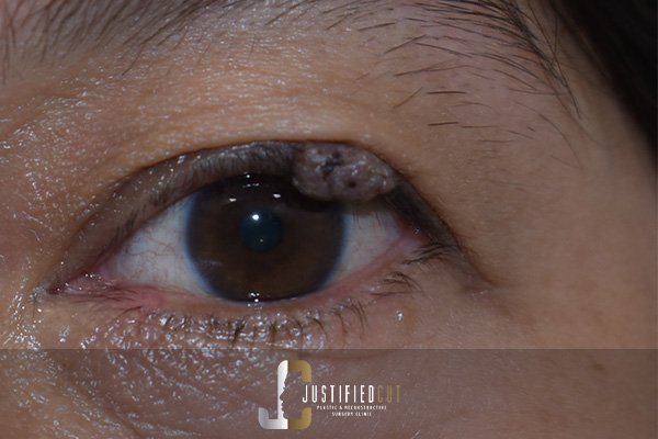 Justified Cut Before Mole Surgery 1