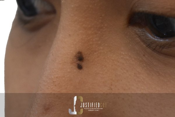 Justified Cut Before Mole Surgery 3