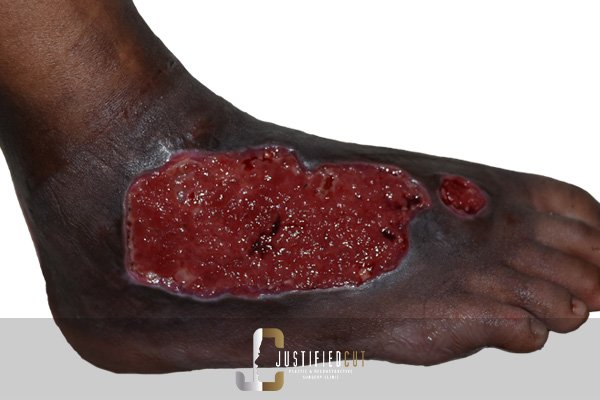 Justified Cut Before Skin Graft Surgery