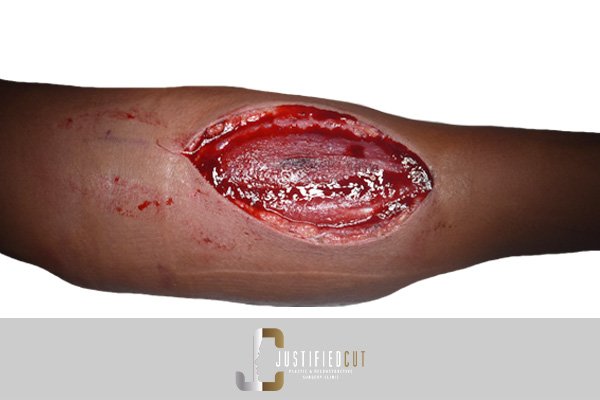 Justified Cut Before Skin Grafting Arm Fracture Surgery