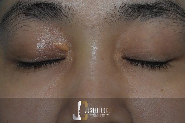 Justified Cut Before Xanthelasma Surgery