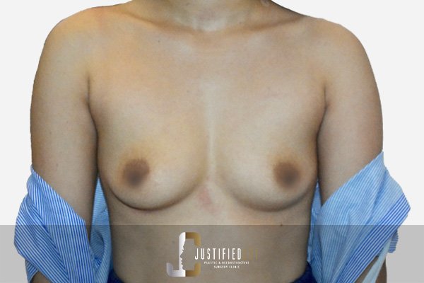 Justified Cut Breast Augmentation Before