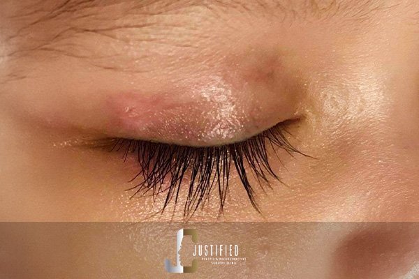 Justified Cut Burn Complications After