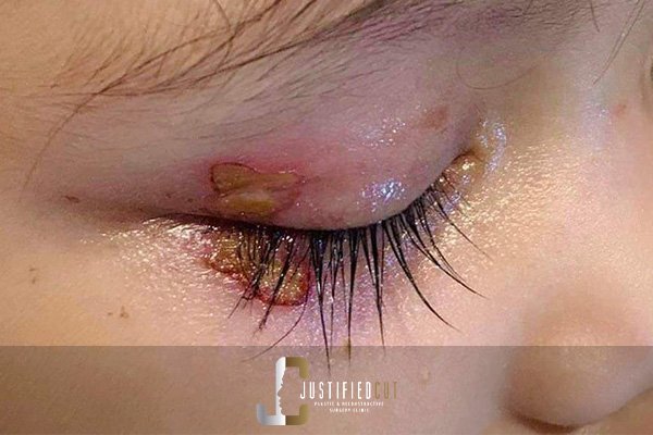 Justified Cut Burn Complications Before