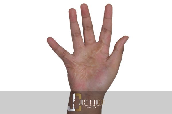 Justified Cut Burn Contracture After