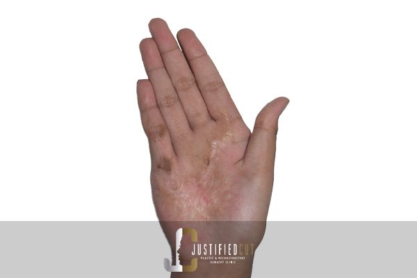 Justified Cut Burn Contracture Before