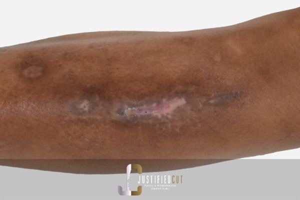 Justified Cut Diabetic Foot After