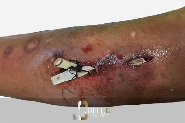 Justified Cut Diabetic Foot Before