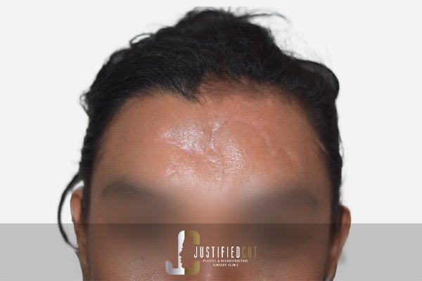 Justified Cut Facial Fracture After