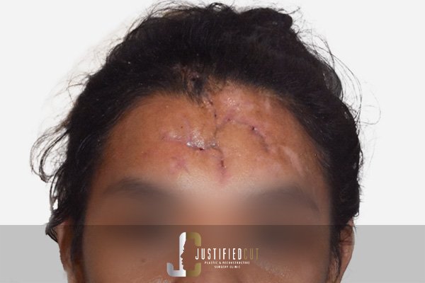 Justified Cut Facial Fracture Before