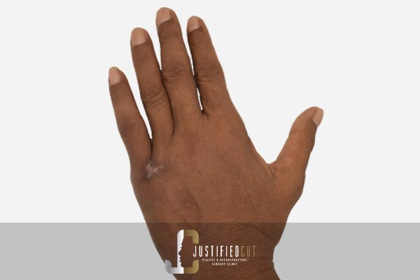 Justified Cut Hand Woud Care After