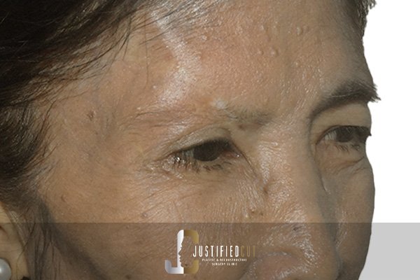 Justified Cut Skin Cancer After