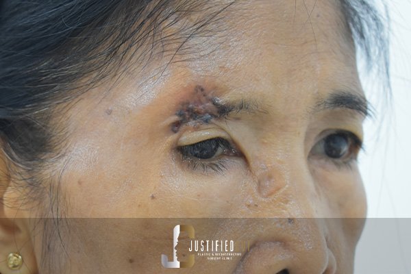 Justified Cut Skin Cancer Before